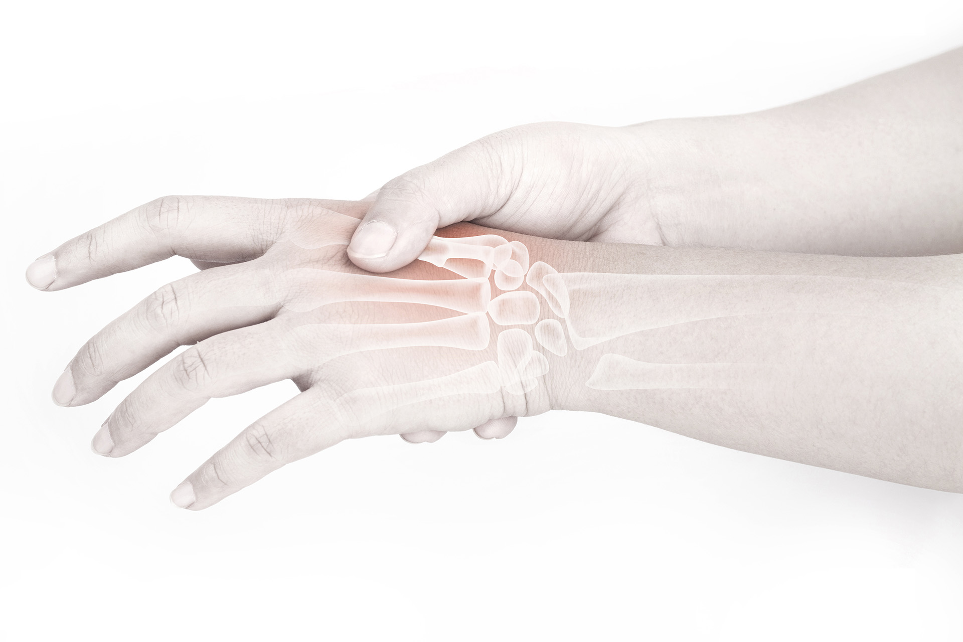 Capsulitis en la articulación interfalángica